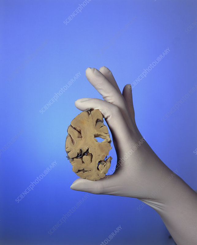 Alzheimer Amp 39 S Woman Improves Her Hand Coordination Stock Image M108 0286 Science Photo Library