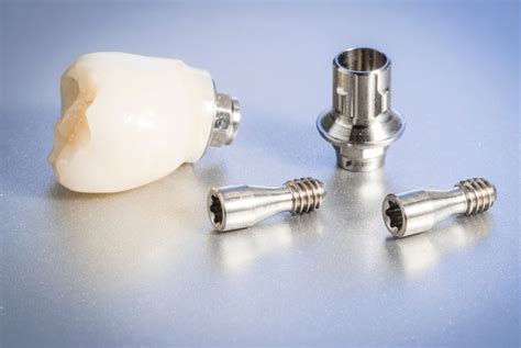 Kiss Principle For Dental Implants Modern Dental Pacific