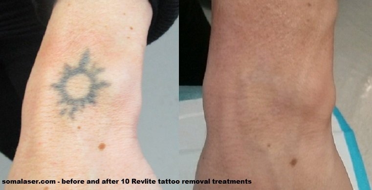 5 Ways to Estimate Laser Tattoo Removal Cost