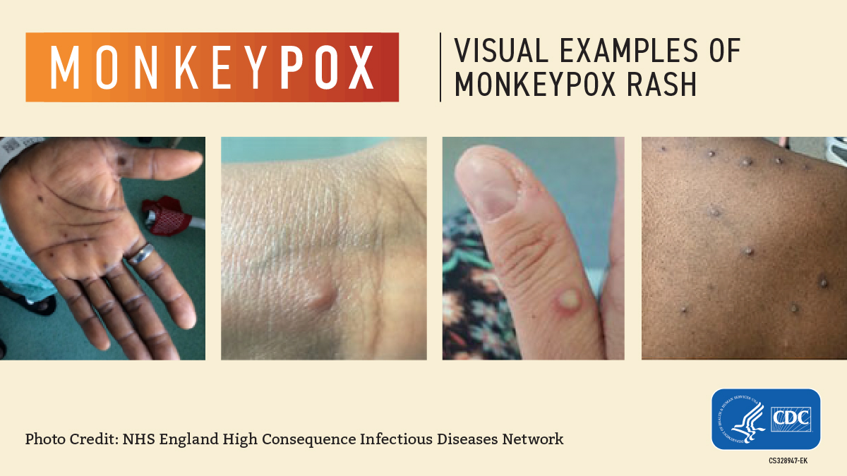 5 Ways to Prevent Monkeypox Health Risks