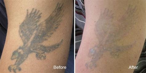 Tattoo Removal Vancouver Remove Tattoos Safely And Fast